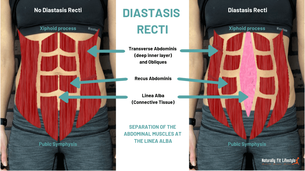 What is diastasis recti?