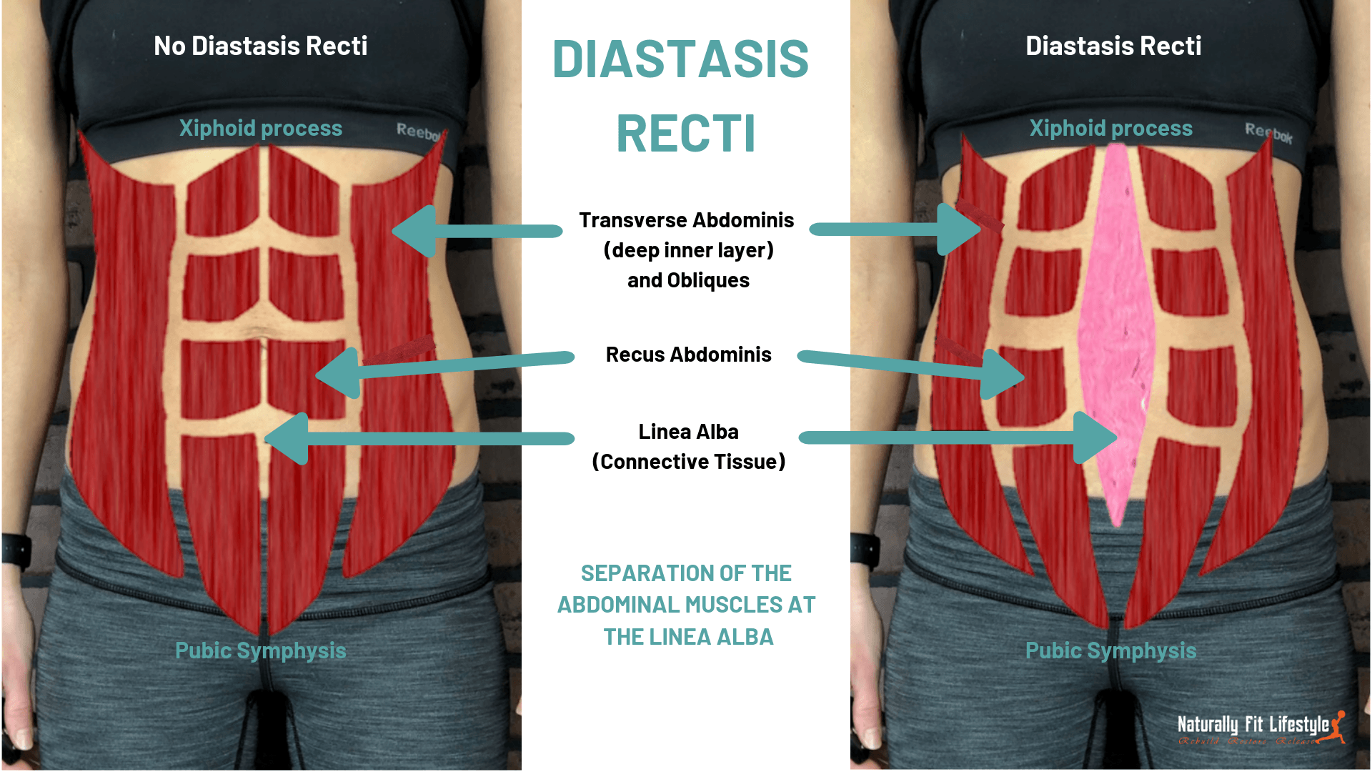 Diastasis Recti: What Is It And What To Do About It ⋆ Naturally