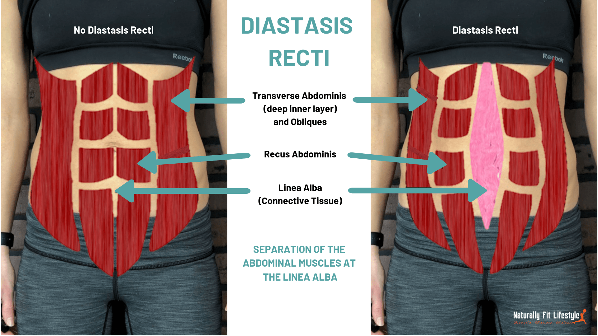Diastasis Recti: What Is It And What To Do About It ⋆ Naturally